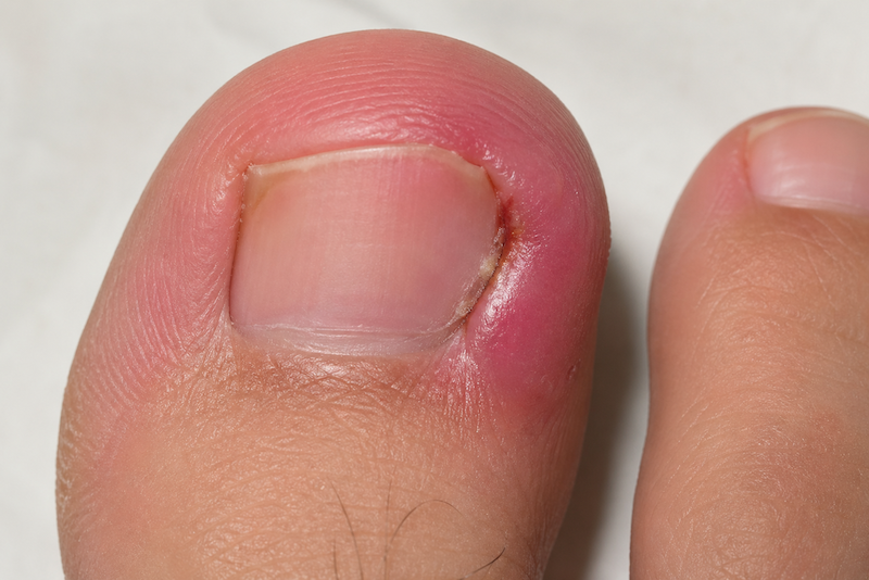 ingrown toenail