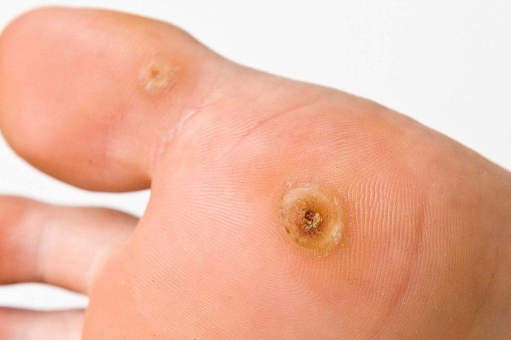 Why Does My Verruca Keep Coming Back? | Paul Miller Podiatry